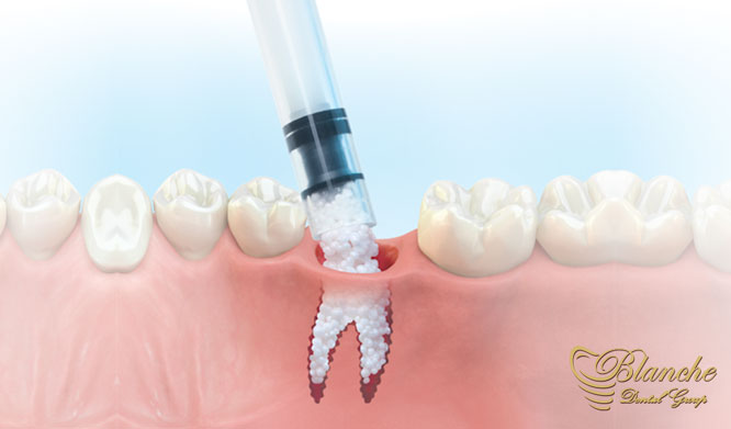 بازسازی و پیوند استخوان در ایمپلنت دندان, Bone Graft in Dental Implant,