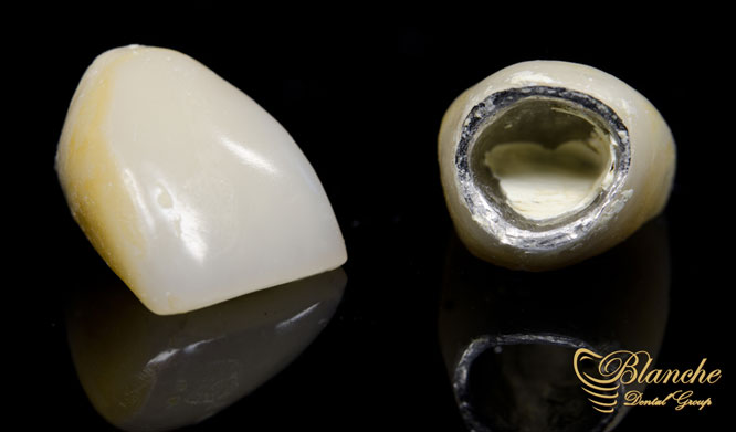 روکش دندان Tooth Crown روکش های دندانی با پرسلن فلزی Porcelain fused metal